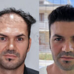 trapianto di capelli in Turchia Dr. Murat Makasci