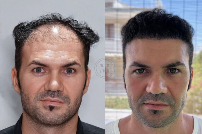 trapianto di capelli in Turchia Dr. Murat Makasci